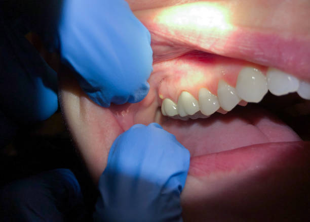 Best Emergency Denture Repair in Tioga, TX